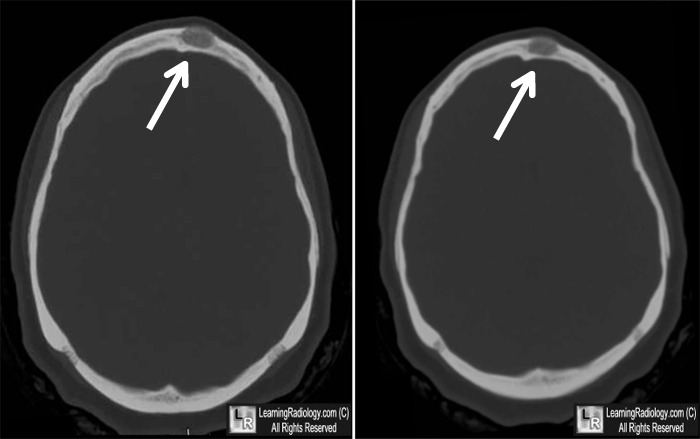 Dermoid Cyst of Skull